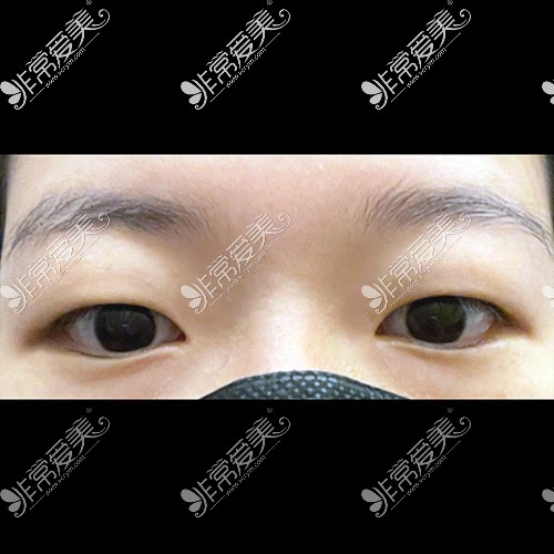 韩国icon整形医院双眼皮术前照