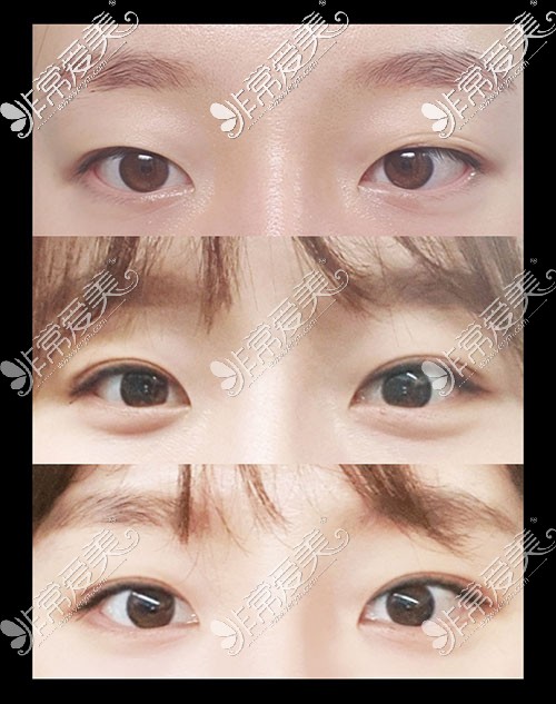 韩国icon双眼皮恢复过程图