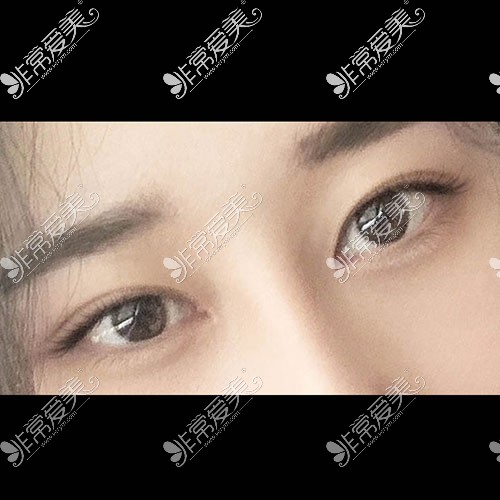 韩国icon双眼皮手术图