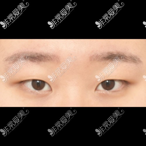韩国icon双眼皮整形术前照片