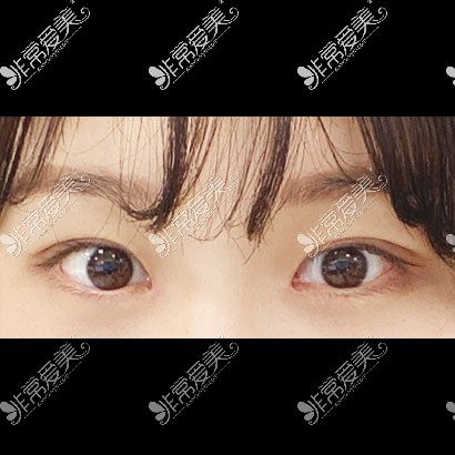 韩国icon整形双眼皮手术