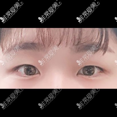 韩国icon整形双眼皮手术图片