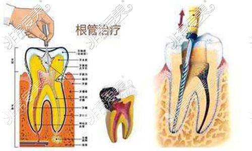 根管治疗示意图