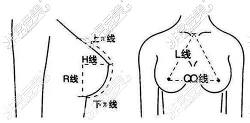 假體豐胸黃金比例