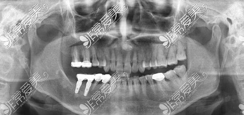 种植牙CT拍照