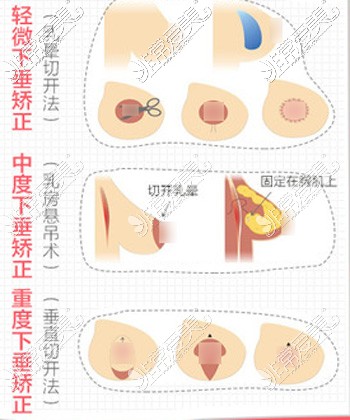 北京艺星医疗美容医院胸部下垂矫正方式