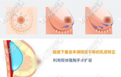 北京童仁医疗美容胸部下垂矫正方式