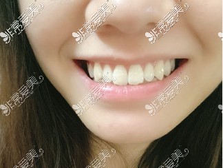 正健口腔洗牙后的牙齿照片