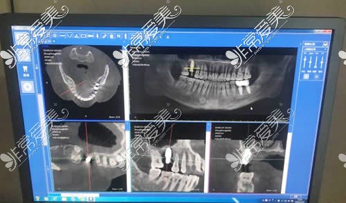 深圳雅适美口腔种植牙CT拍摄
