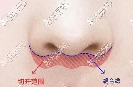 人中缩短手术鼻基底切口区域