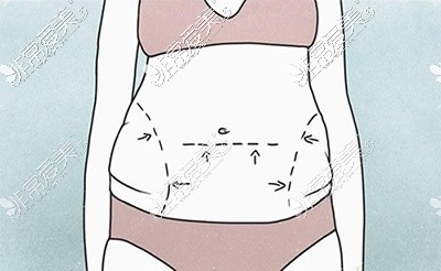 腰腹吸脂卡通图展示
