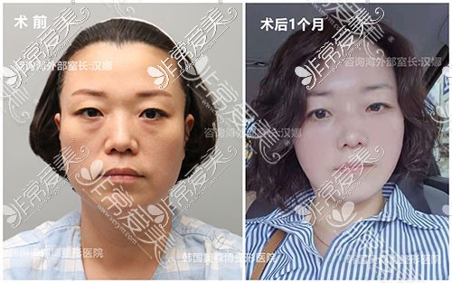 韩国德丽珍拉皮手术对比图