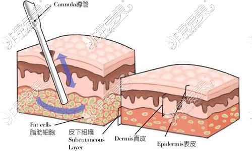 吸脂手术塑形