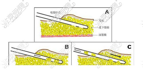 吸脂手术塑形