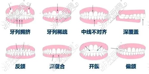 贵阳牙齿矫正价格