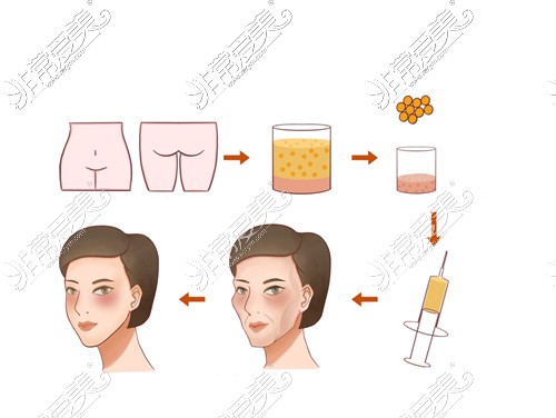 自体脂肪脸部填充卡通图