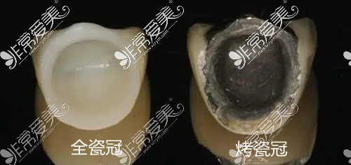 全瓷牙冠和烤瓷牙冠