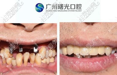 广州曙光口腔种植牙修复
