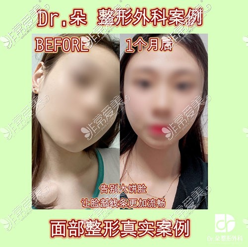 韩国dr朵轮廓手术照片