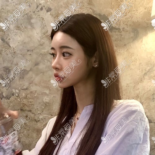 韩国优雅人隆鼻术后照片