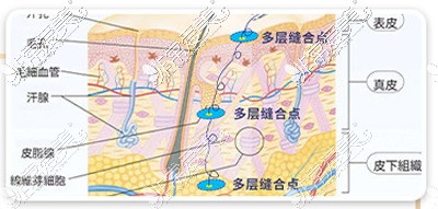 北京好年華眼整形縫合圖解