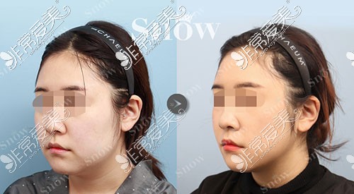 韩国snow整形面部轮廓手术