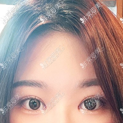 韩国icon整形做眼睛手术照片