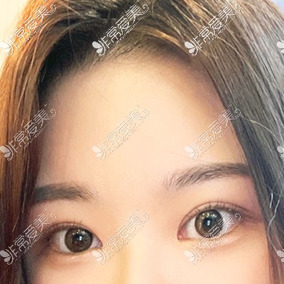 韩国icon整形做眼睛怎么样