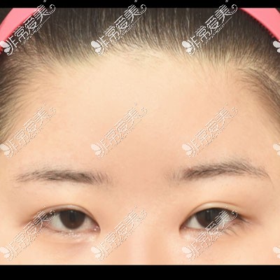 韩国icon整形非切开眼型矫正手术