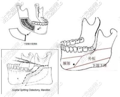 下颌角外板示意图