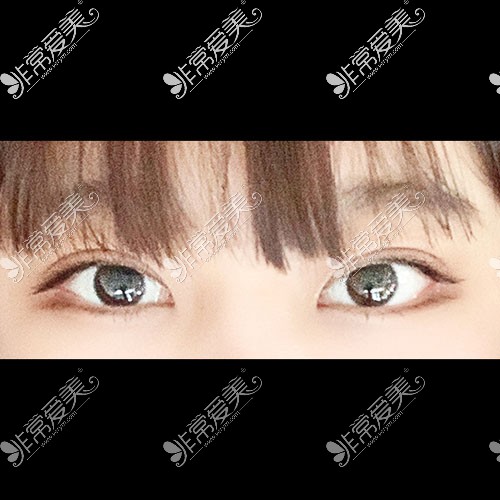 韩国icon整形双眼皮手术照片