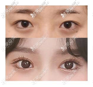 韩国icon双眼皮手术对比照