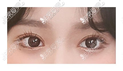 韩国icon双眼皮手术图片