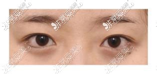 韩国icon双眼皮手术术前照片