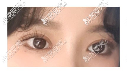 韩国icon双眼皮手术术后图片