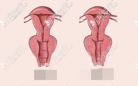 缩阴手术对比漫画