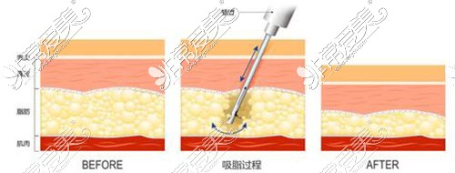 吸脂示意图