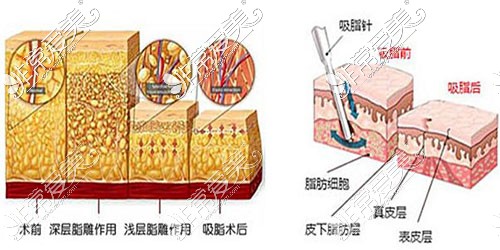 吸脂示意图