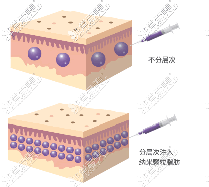 自体脂肪填充特点展示