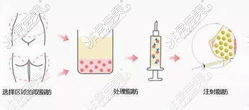 洛阳做隆胸价格费用多少钱？分享洛阳丰胸哪个医院好