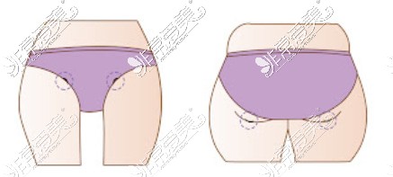 大腿吸脂入針部位