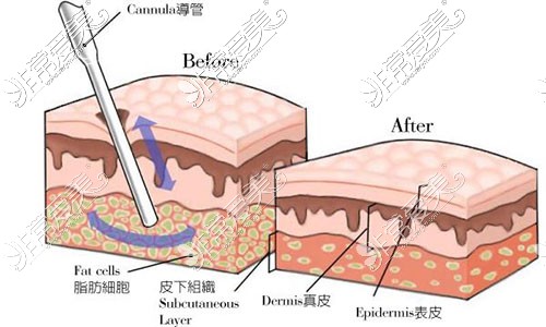 吸脂手術(shù)塑形