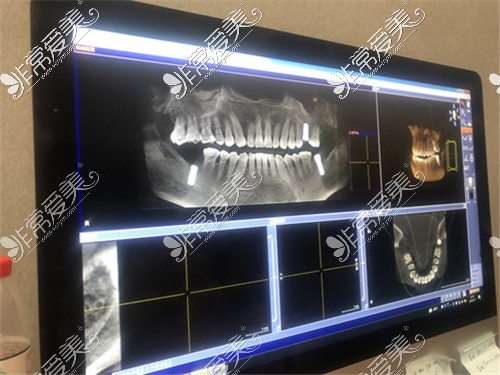 上海松丰齿科种植牙顾客CT图