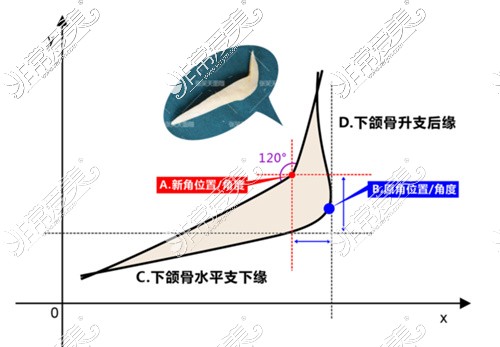 张笑天医生下颌角手术图解