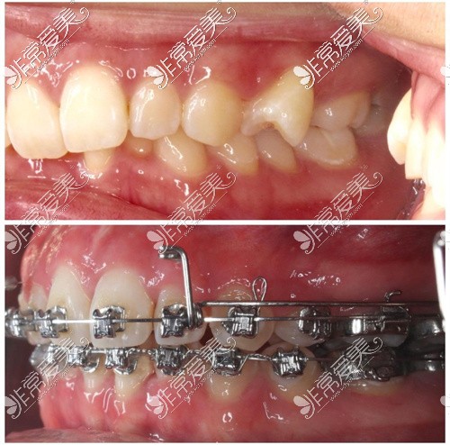 泸州牙齿矫正实拍图