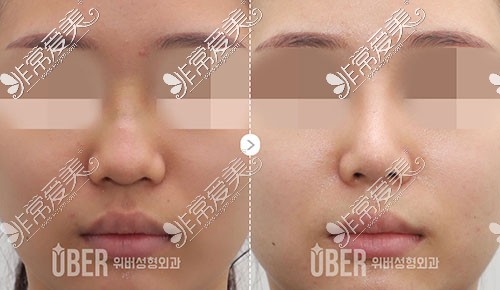 韩国玉芭凸嘴隆鼻手术图片