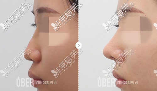 韩国玉芭隆鼻手术前后对比图