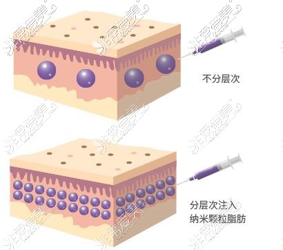 自体脂肪填充面部填充特点分析