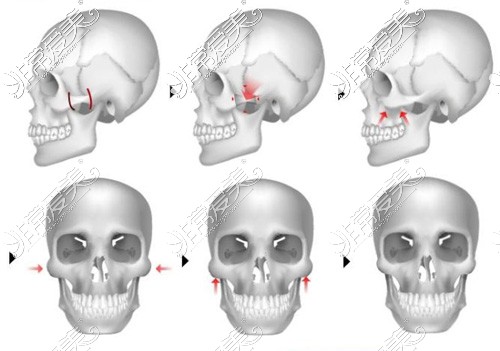 颧骨颧弓位置I型截骨