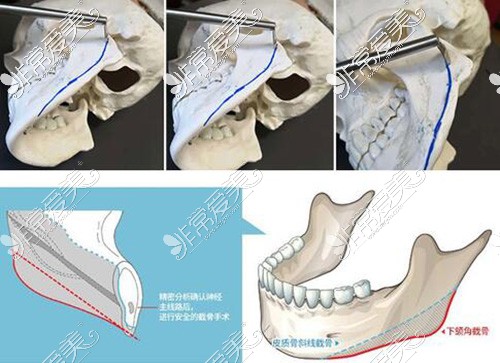 下颌角磨骨改善照片展示